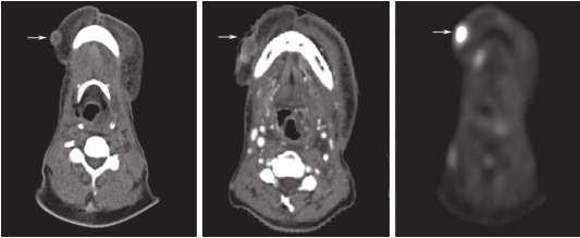 图1 右侧下颌体右前份皮下软组织结节影（平扫CT，增强CT和PET-CT）.jpg